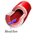 Coronary artery restored to health with the Lp(a) binding inhibitors vitamin C, lysine and proline and no longer in need of reinforcing plaque.